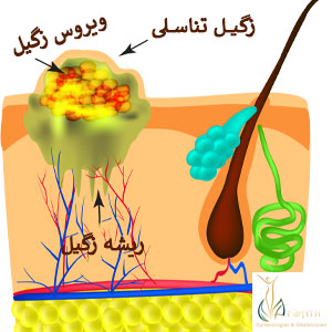 عکس زگیل تناسلی زنان