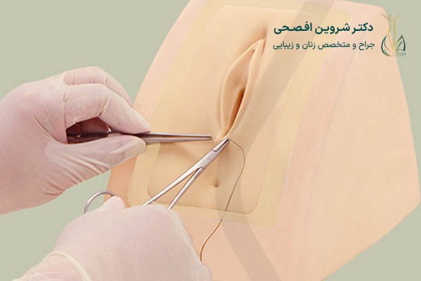 روش انجام جراحی زیبایی واژن پس از زایمان