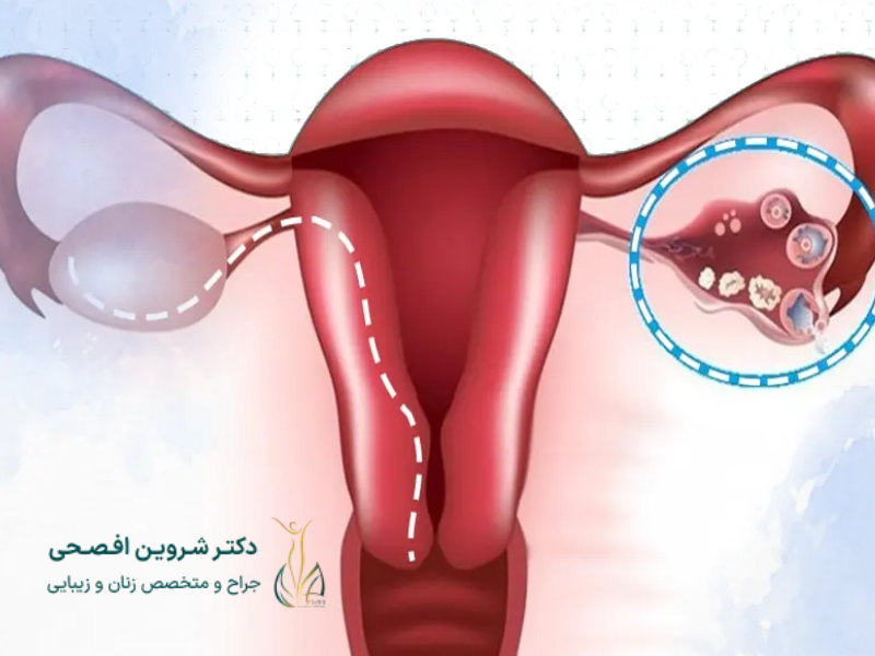 آیا کیست تخمدان نشان دهنده ابتلا به سرطان است!