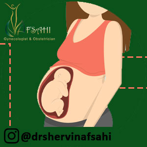 شکل قرارگیری جنین در زایمان بریچ