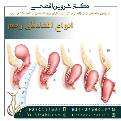 انواع افتادگی رحم