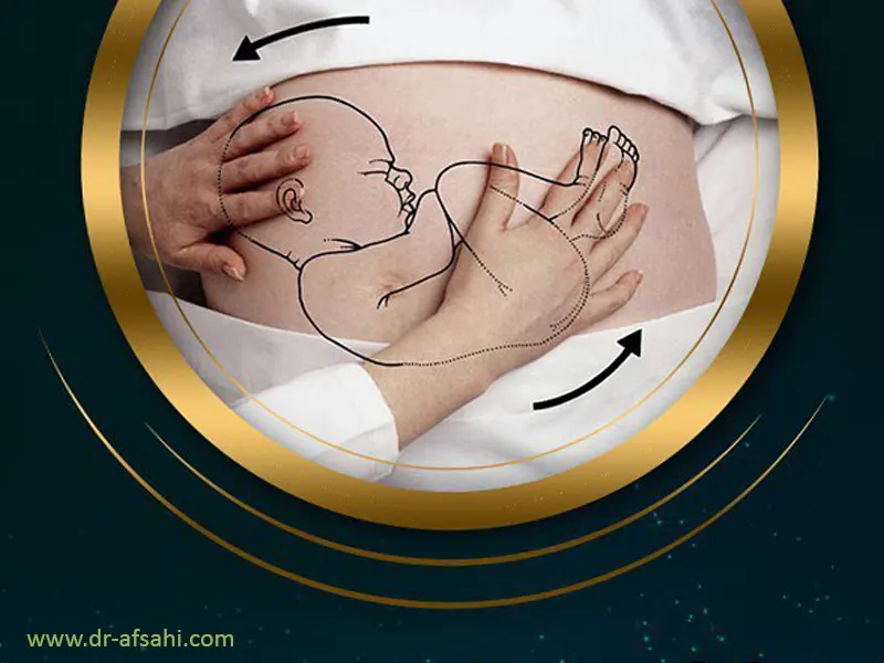 بهترین دکتر زایمان سزارین