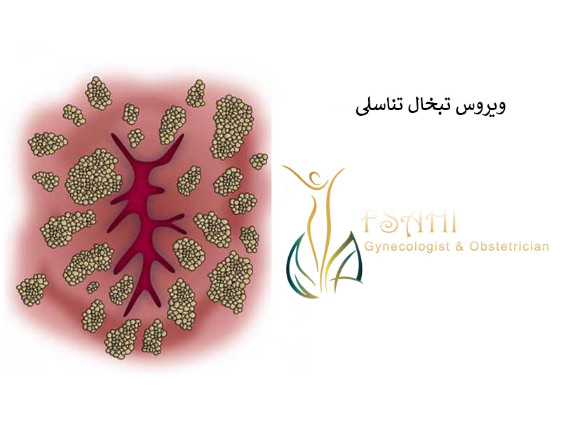 تبخال-تناسلی