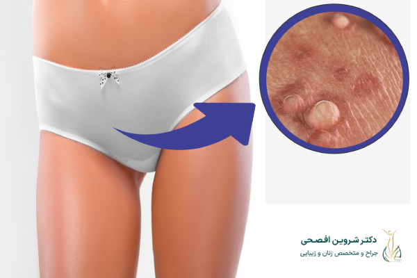 زگیل تناسلی چیست و چرا باید درمان شود؟