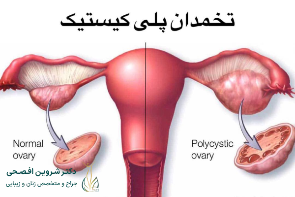 درمان نشدن سندروم تخمدان پلی کیستیک چه خطراتی دارد؟