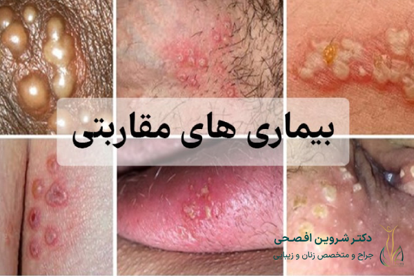 بیماری‌های مقاربتی