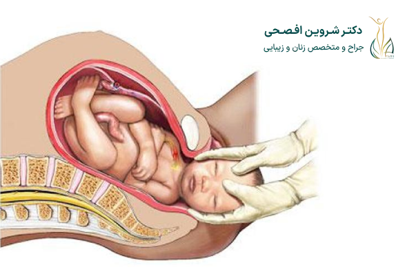 انواع زایمان بعد از جراحی کلیتوریس یا هودکتومی