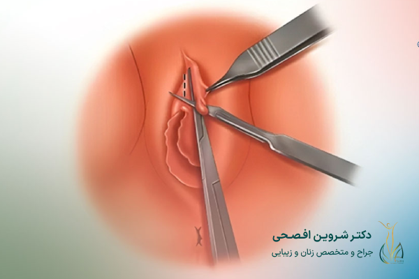 خطرات زایمان طبیعی بعد از جراحی کلیتوریس