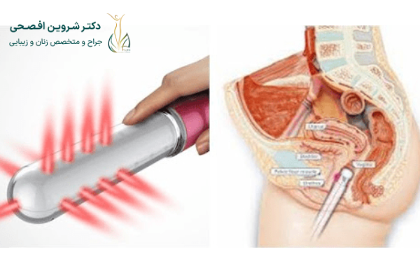 جوانسازی واژن با آر اف چیست؟