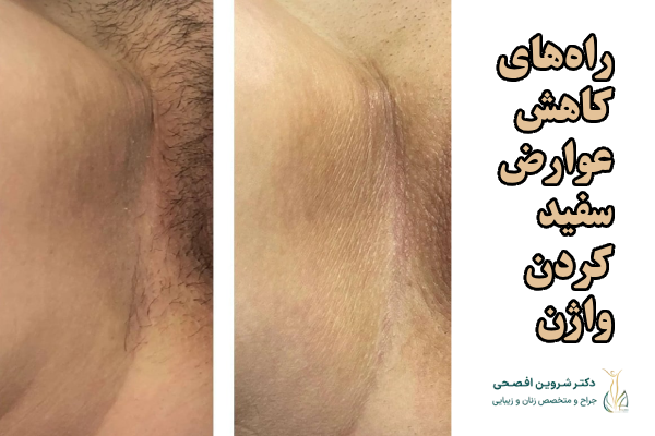 راههای کاهش عوارض سفید کردن واژن
