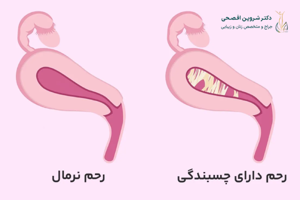 تشخیص چسبندگی رحم