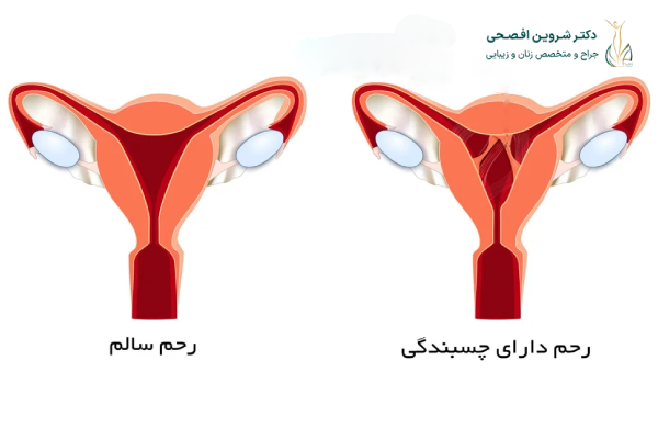 علت بروز چسبندگی رحم