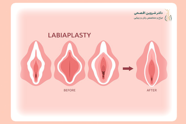 فواید لابیاپلاستی چیست؟